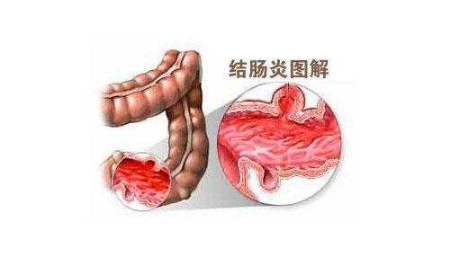 結腸炎
