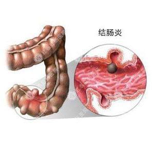 潰瘍性結腸炎