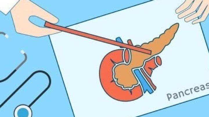 胰腺結石