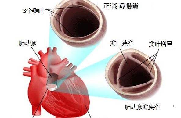 肺動(dòng)脈狹窄