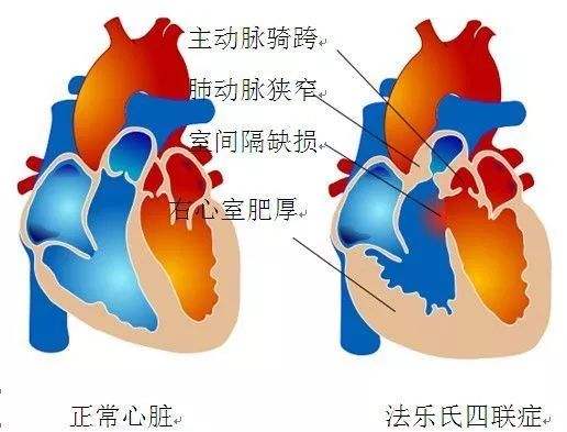法洛四聯(lián)癥
