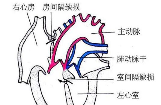 心內膜墊缺損