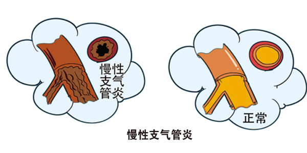 慢性支氣管炎