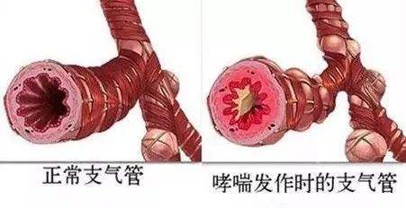 支氣管哮喘
