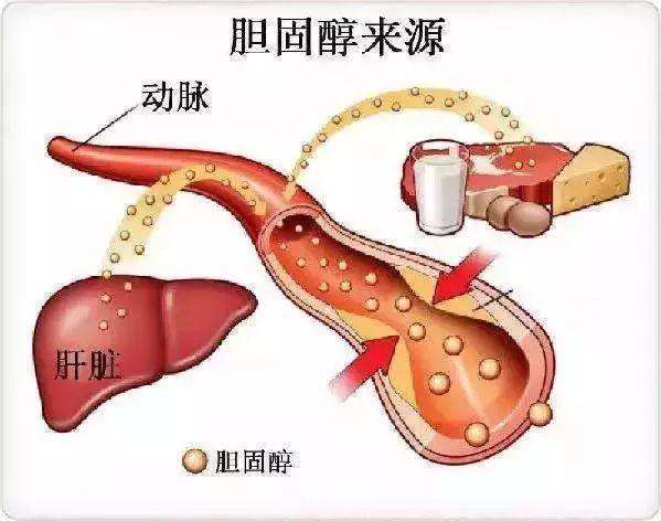 高膽固醇血癥