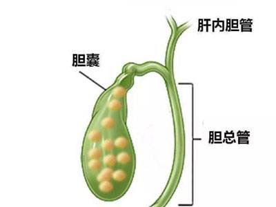 膽囊結石