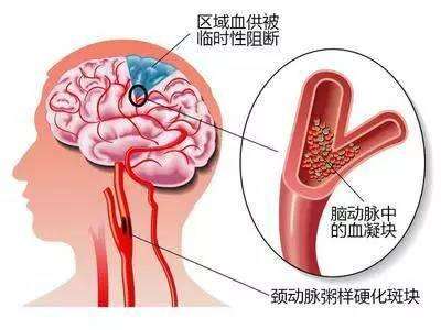 腦動脈硬化