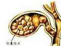 膽結石