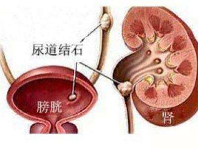 膀胱結石