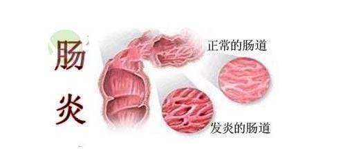 腸炎