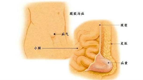 腹股溝疝