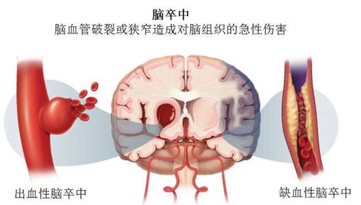 腦卒中