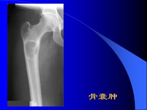 骨囊腫