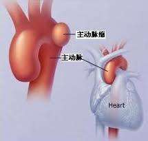 胸主動(dòng)脈瘤