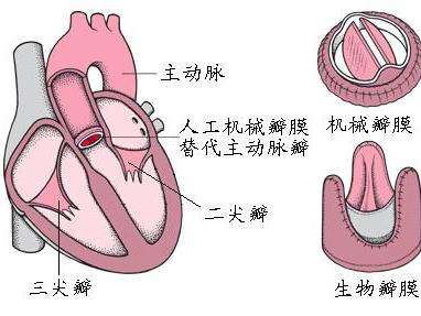 心臟瓣膜置換術
