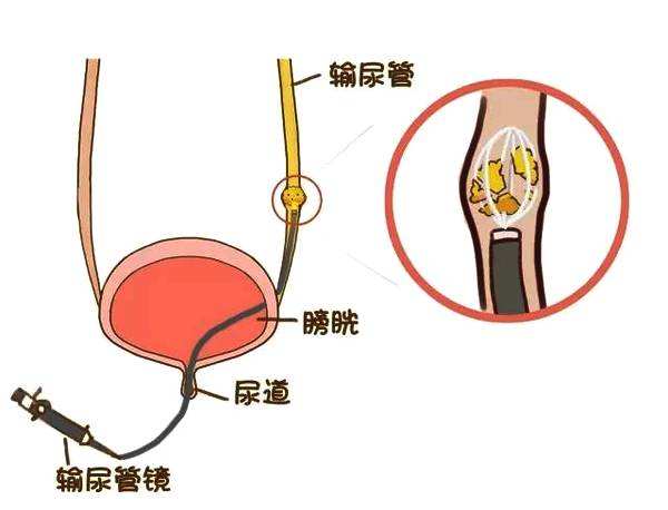 輸尿管結石