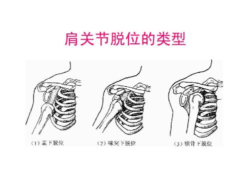 肩關節脫位