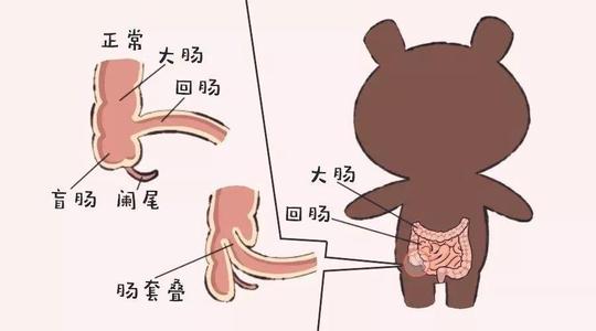 腸套疊