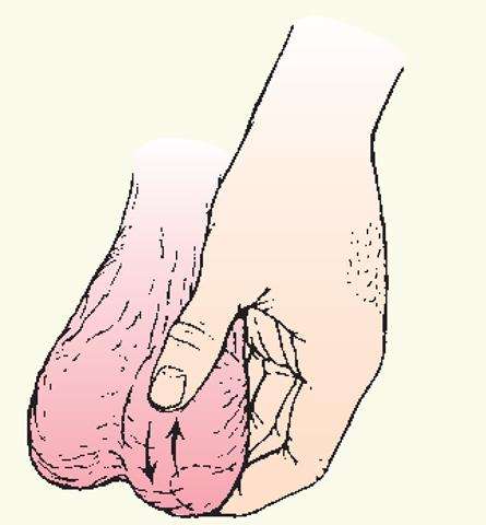 陰囊癌