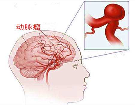 腦動脈瘤