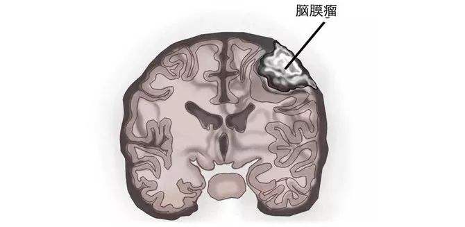 腦膜瘤