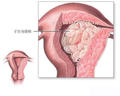 子宮內膜癌