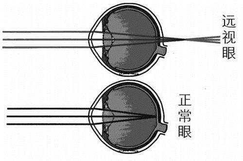 遠視