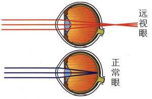 遠視眼