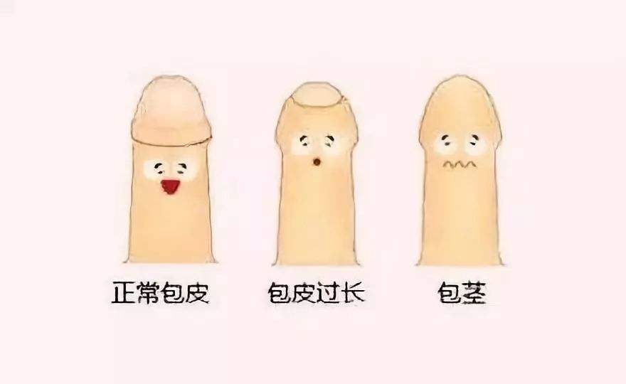 包皮過長(zhǎng)