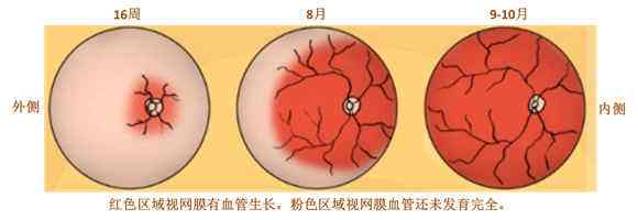早產兒視網膜病變