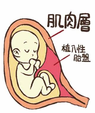 胎盤植入