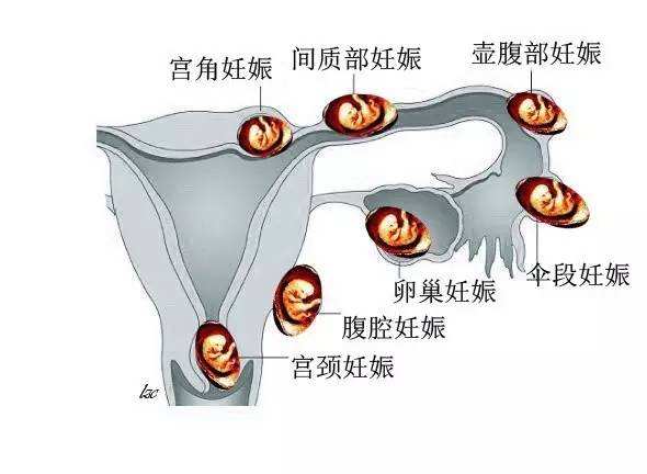 輸卵管妊娠