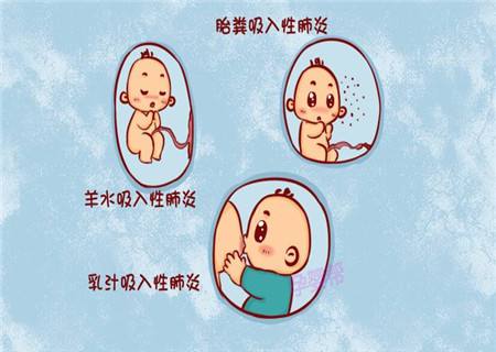胎糞吸入綜合征