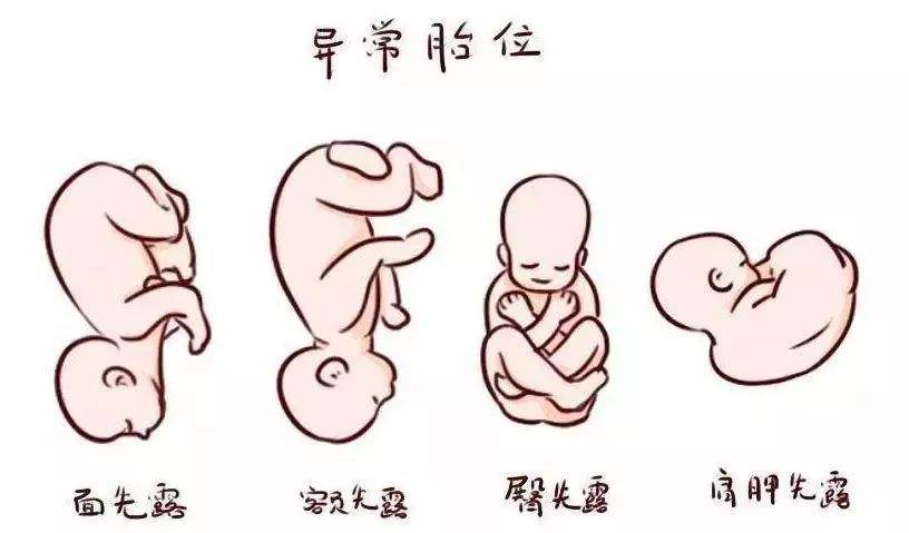 胎位異常