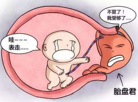 前置胎盤