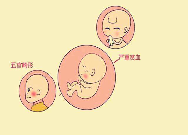 胎兒先天畸形