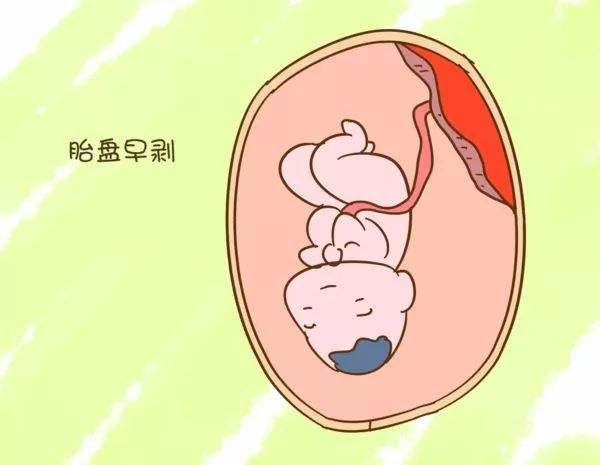 胎盤早剝