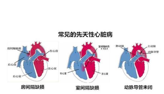 胎兒先天性心臟病