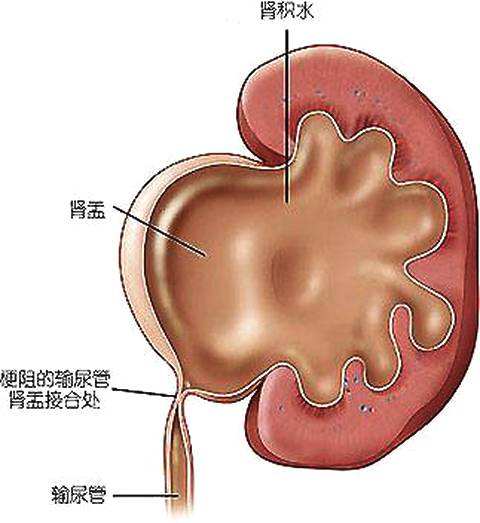 小兒腎積水
