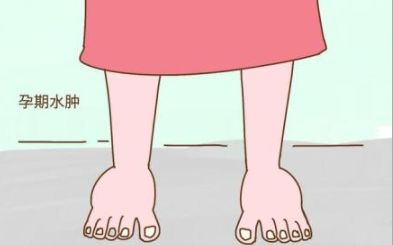 妊娠水腫