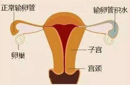 輸卵管積水