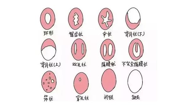 處女膜閉鎖