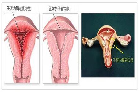 子宮內膜增生