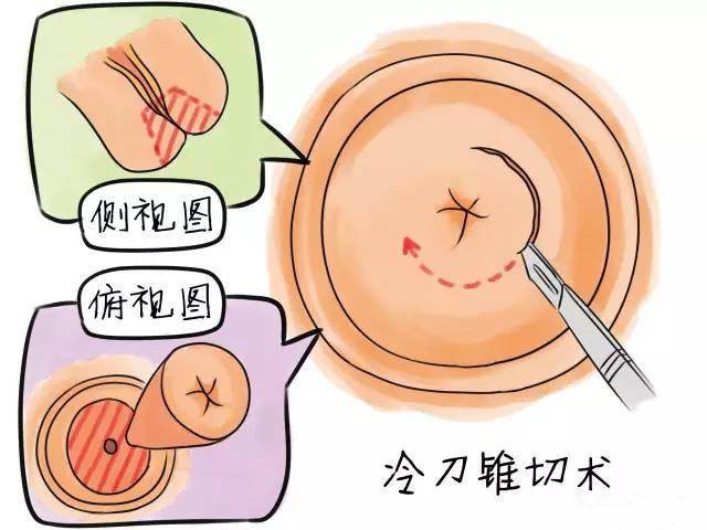 宮頸錐切術(shù)
