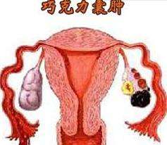 巧克力囊腫