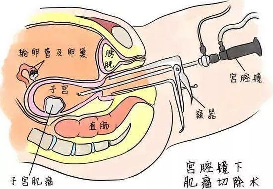 宮腔鏡