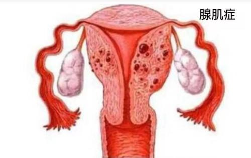 腺肌癥