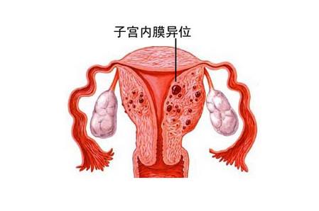 子宮內膜異位癥