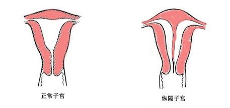 子宮縱膈