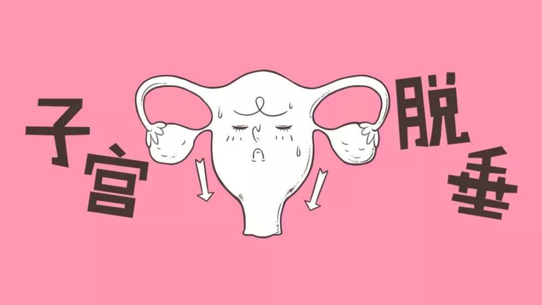 子宮脫垂